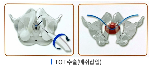 TOT 수술 메쉬삽입 이미지