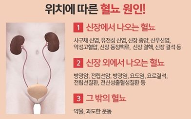 위치에 따른 혈뇨 원인 이미지