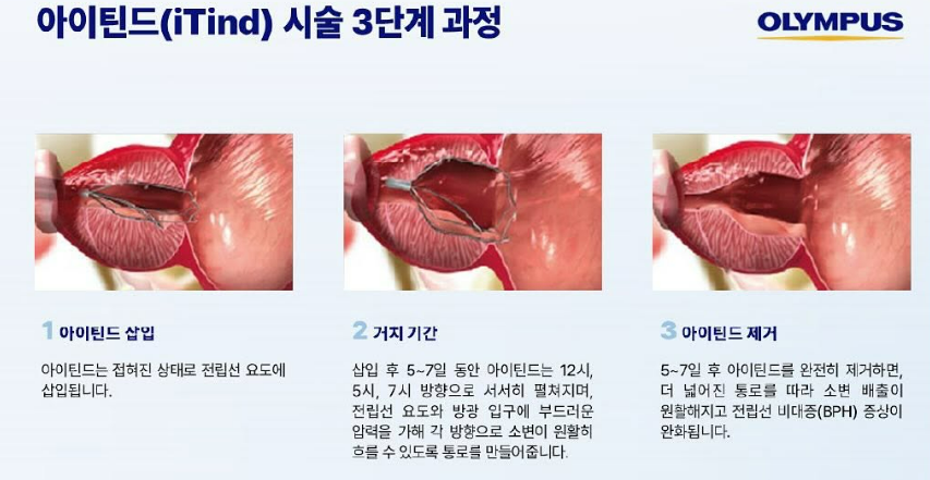 아이틴드 시술 3단계 과정 - 삽입, 거치 기간, 제거