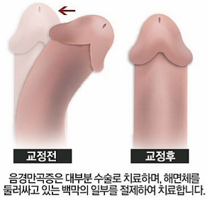 음경만곡증 교정 전후 비교 이미지