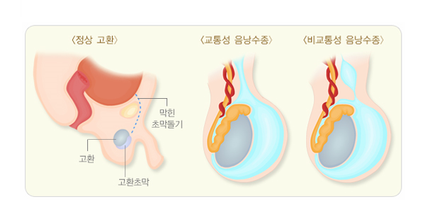 정상 고환, 교통성 음낭수종, 비교통성 음낭수종 비교 일러스트